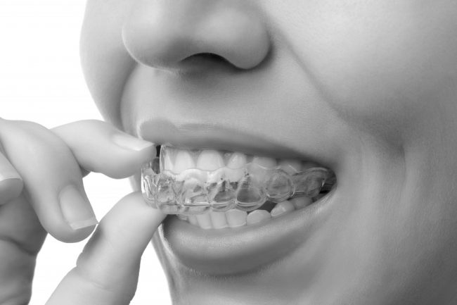 bigstock-Woman-Wearing-Orthodontic-Sili-111518951